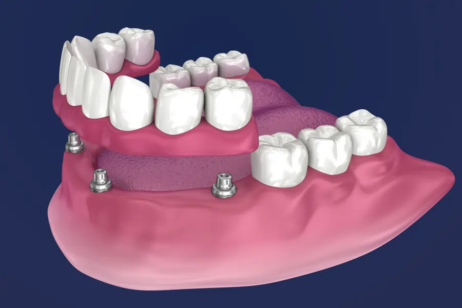 illustration of implant supported dentures